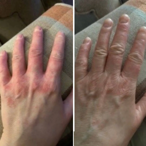 Dermatitis Control & Healthy Skin Cream - Relieves Itching, Redness & Flaking 50ml photo review